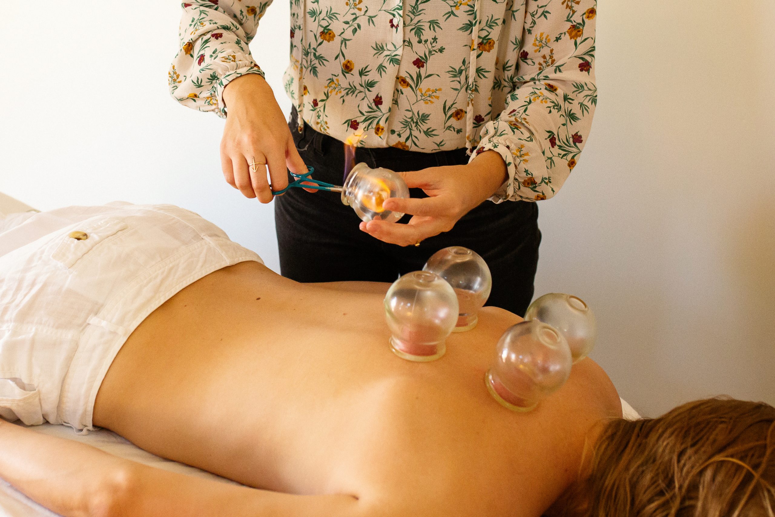 Acupuncture cupping photo, patient on table receiving cupping treatment by Dr. Marketing & branding photography by San Francisco Bay Area photographer Ella Sophie. Lifestyle branding images. 